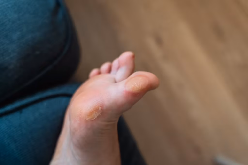 close up of a soft callus on a foot of a woman sp 2026 03 16 22 57 45 utc