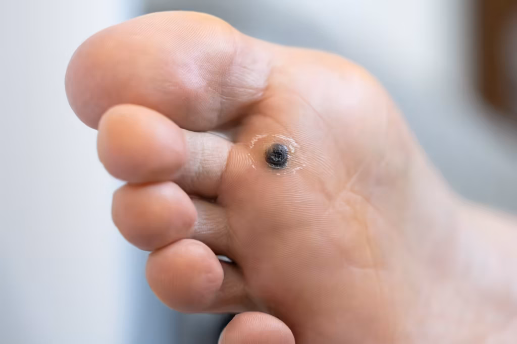closeup of wart plantar after cauterizing it with 2026 03 19 23 21 19 utc